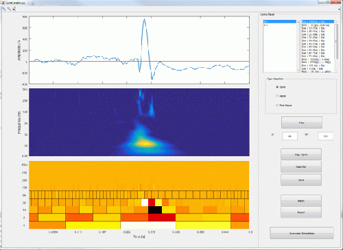 Animated extraction of an epileptic spike in SEEG recording